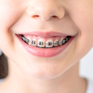 Ortodonta Toruń – aparat dla dziecka